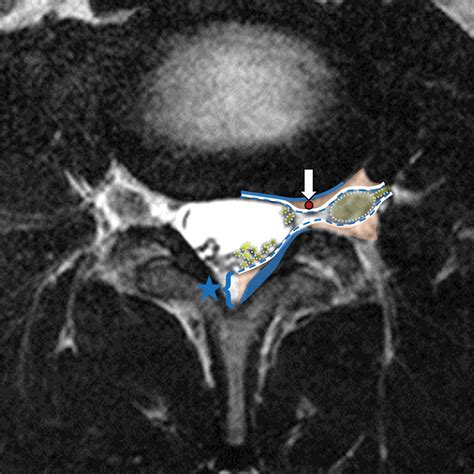Fluoroscopically Guided Epidural Injections of the Cervical and Lumbar