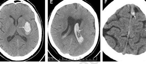 2 Ischemic and haemorrhagic stroke on CT. (a) Normal CT (typical ...