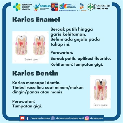 Tahapan Karies Gigi Puskesmas Pancasan