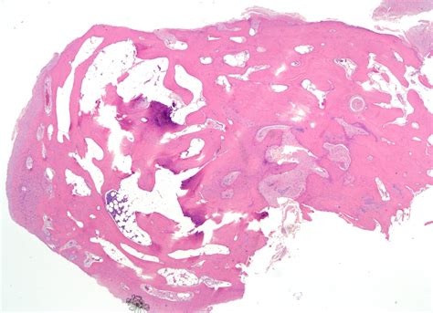 Pathology Outlines - Osteocartilaginous loose bodies