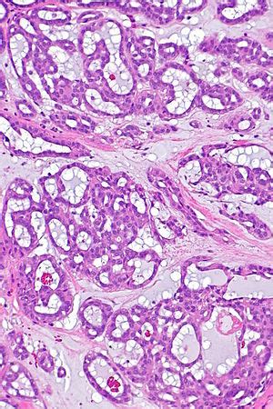 Cribriform Adenocarcinoma