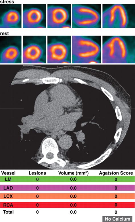 Cardiac Petct For The Evaluation Of Known Or Suspected Coronary Artery