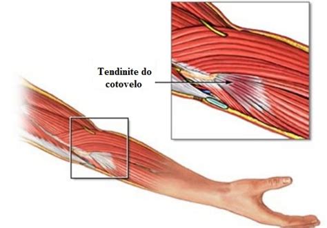 O Que É Tendinite No Braço - Como tratar a tendinite naturalmente - Melhor Com Saúde