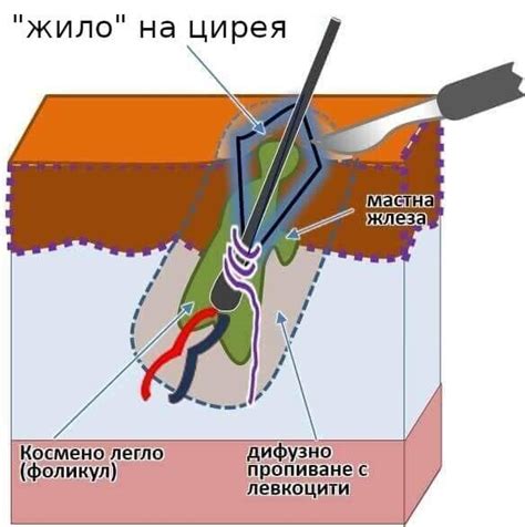 Лечение на цирей (фурункул) и карбункул - МЦ "Свети Пантелеймон"