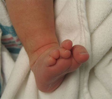 Overlapping Toes Are Characterized By One Toe Lying On Top Of An Adjacent Toe The Fifth Toe Is