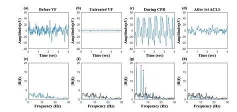 EEG changes in animal 1: (a) irregular baseline EEG activity before VF ...