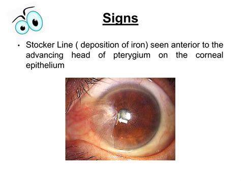 Pterygium Colli Deformity 1