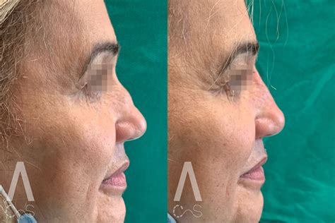 Liquid Rhinoplasty Archives Alessi Medical Spa