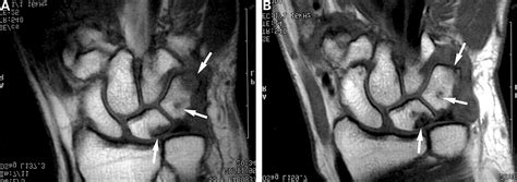 What Is The Fate Of Erosions In Early Rheumatoid Arthritis Tracking Individual Lesions Using X