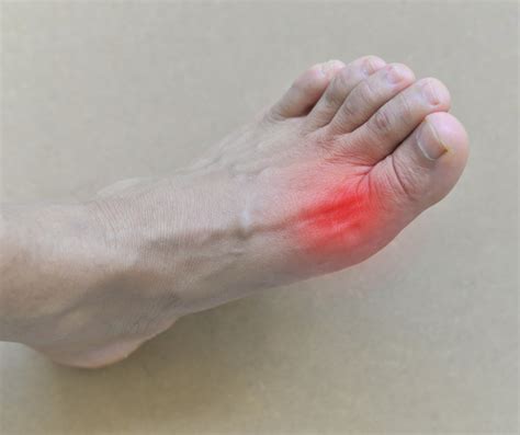 Everything You Need To Know About Gout Advanced Feet Ankle Care