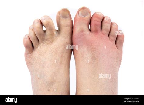 Gout Foot High Resolution Stock Photography And Images Alamy