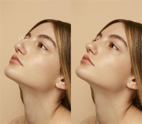 3 Cara Memancungkan Hidung Di Klinik Kecantikan Plasthetic Clinic