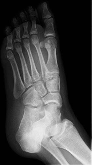 Fractura Luxaci N De Lisfranc En Adolescente Una Lesi N Poco N