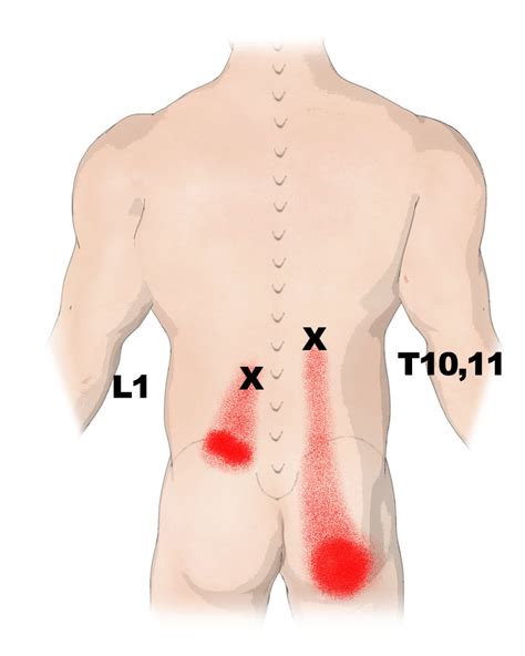 Erector Spinae Trigger Points