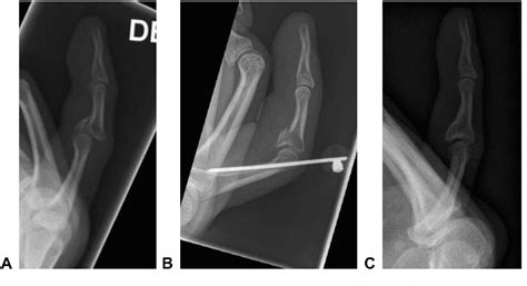 Figure From Extension Block Pinning For Unstable Proximal