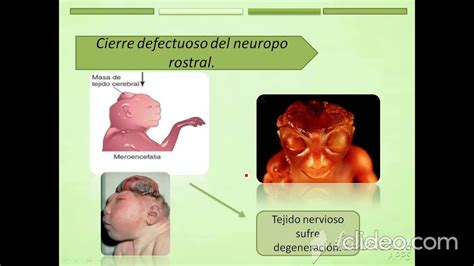 Defectos De Cierre Del Tubo Neural Youtube