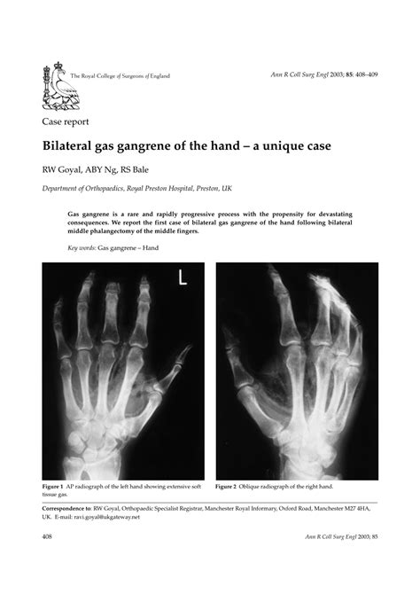 Pdf Bilateral Gas Gangrene Of The Hand A Unique Case