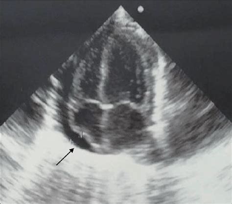 echocardiogram showing  pericardial effusion pce  systolic