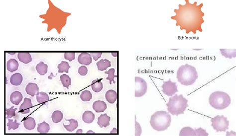 Spur Cell (Acanthocyte) And Burr Cell (Echinocyte), 48% OFF