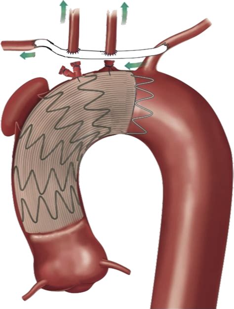 Reverse Extra Anatomic Aortic Arch Debranching Procedure Allowing