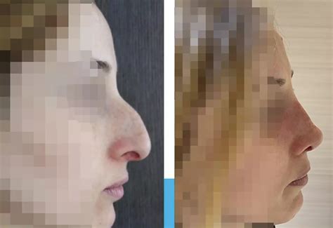 Pourquoi Faire Une Rhinoplastie En Tunisie Estetika