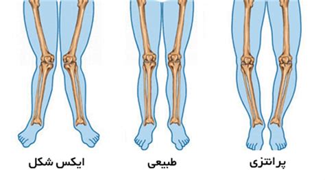 شرایط معافیت پزشکی پاپرانتزی ژنووالگوم یا ژنوواروم