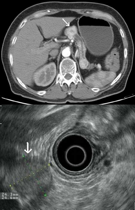 CT And EUS Fi Ndings Of Case 1 A Near 30 Mm Solid Lesion In The Head