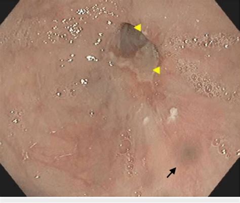 Esophagogastroduodenoscopy Showing Bluish Discoloration At The Distal Download Scientific