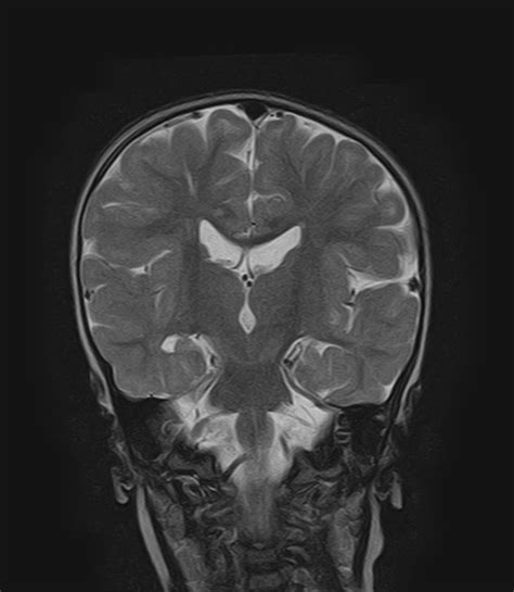 Periventricular Leucomalacia Frontal Arachnoid Cyst Image