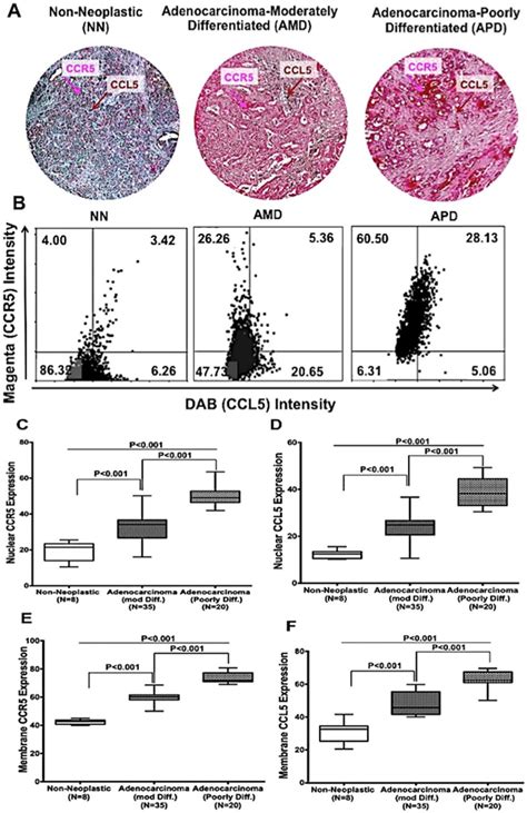 Ccr5 And Ccl5 Expression In Pancreatic Cancer Tissues A Pancreatic