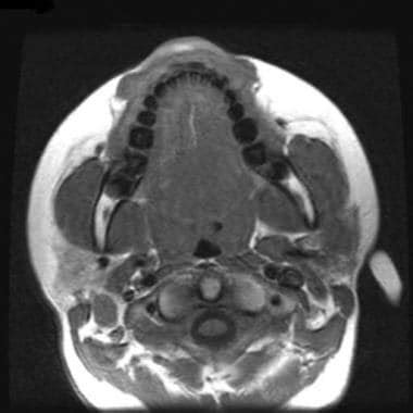 Malignant Parotid Tumor Imaging Practice Essentials Radiography