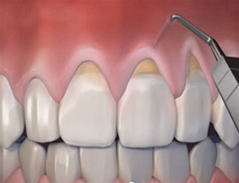 Chao Pinhole Surgical Technique Pst™ Dental Implants And Periodontics