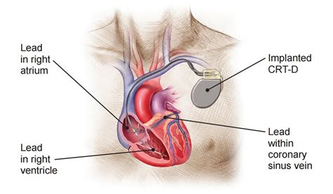 Cardiac Resynchronisation Therapy Crt D Dr Rakesh Jain