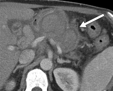 Ct After Pancreaticoduodenectomy Spectrum Of Normal Findings And