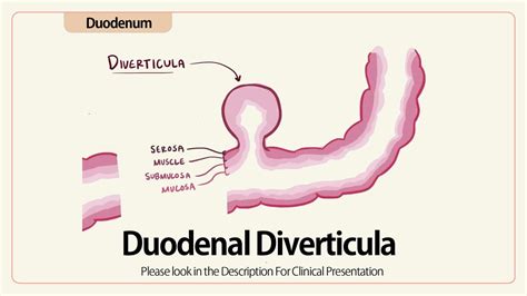 Linear Eus Duodenal Diverticulum Youtube