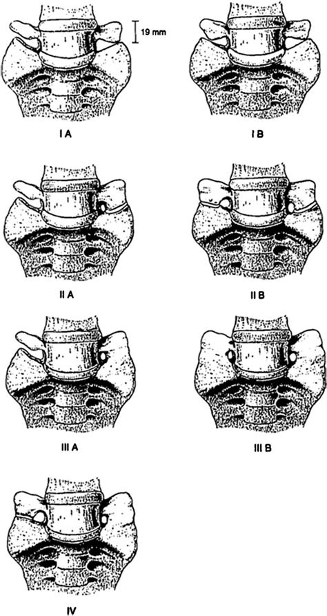 Skull And Spine Lumbosacral Transitional Vertebrae