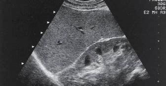 MEDICAL ULTRASOUND/SPLENOMEGALY