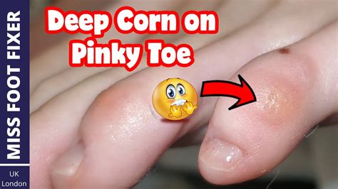 Corn On Foot Pinky Toe Hotsell | emergencydentistry.com