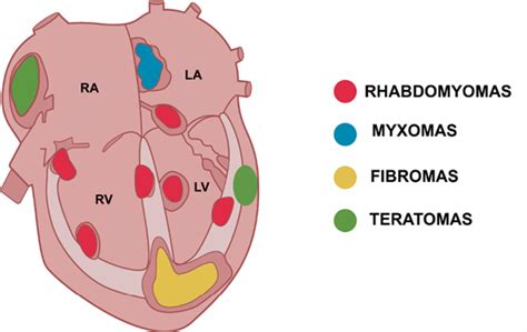 Tumores Cardíacos Pediátricos Características De Imagens Ecocardiográficas Abc Imaging