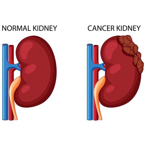 Kidney Cancer: Early Symptoms Warning Signs | Dr. Sumit Sharma