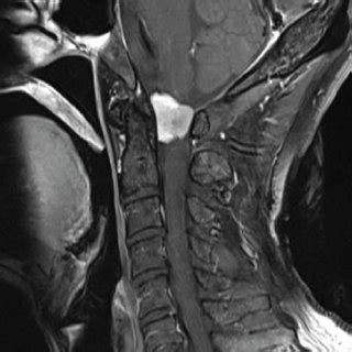 (a) T2-weighted sagittal MRI of the cervical spine showed a tumor in ...