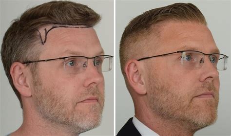 Neograft Hair Transplant Chandigarh Reviews Mira Mcintyre