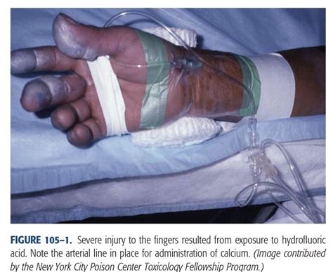 Hydrofluoric Acid Burns
