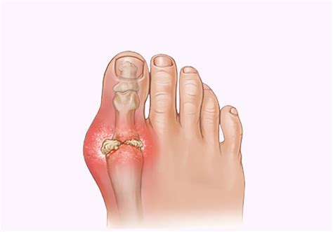 Gout Pain in Heel: Heel Pain Gout Symptoms and Treatment