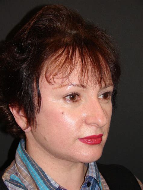 Mini Facelift Orange County Mini Facelift Mission Viejo Ca