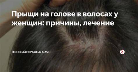 Прыщи на голове в волосах: причины появления и лечение у женщин и мужчин