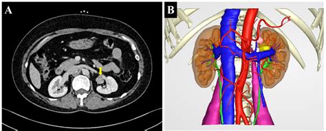 Frontiers Case Report An Ectopic Adrenocortical Adenoma In The Renal