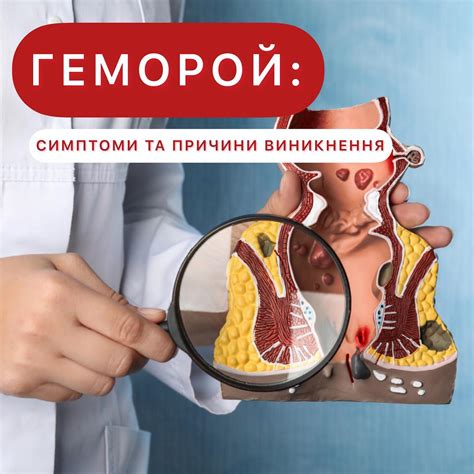 Геморой: симптоми та причини виникнення — Медичний центр Integro в Черкасах