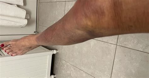 Bruised leg?