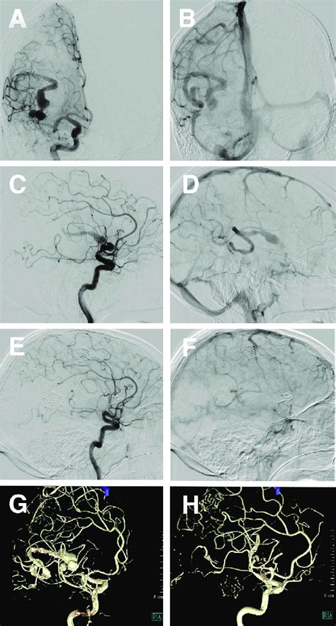 A Digital Subtraction Angiography Dsa Ap View Arterial Phase Shows